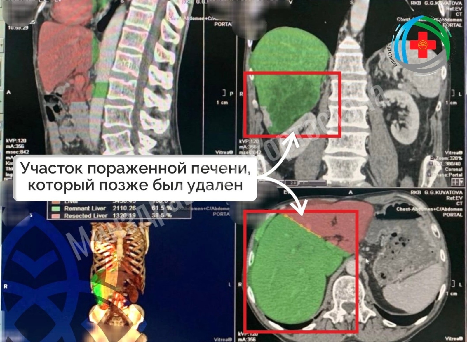 Жителю Башкирии вырезали часть печени и «нарастили» новую