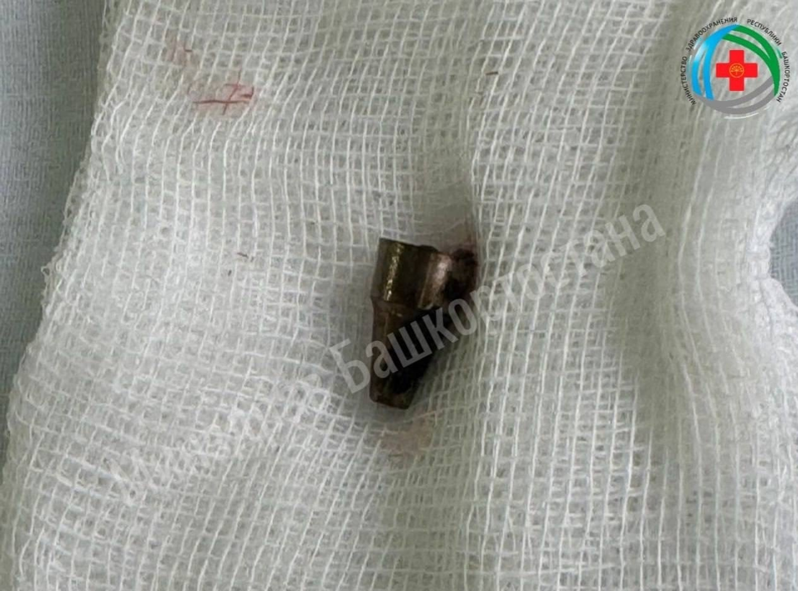 В Башкирии хирурги извлекли из уха женщины наконечник ручки