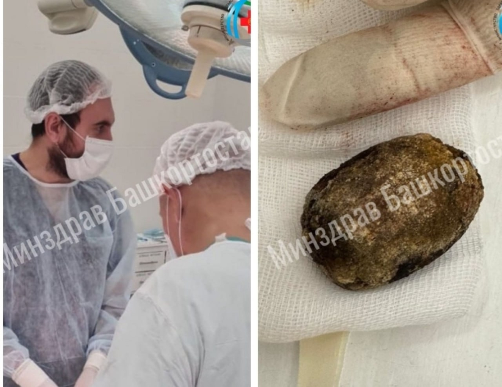 Врачи нашли огромный камень в женщине из Башкирии