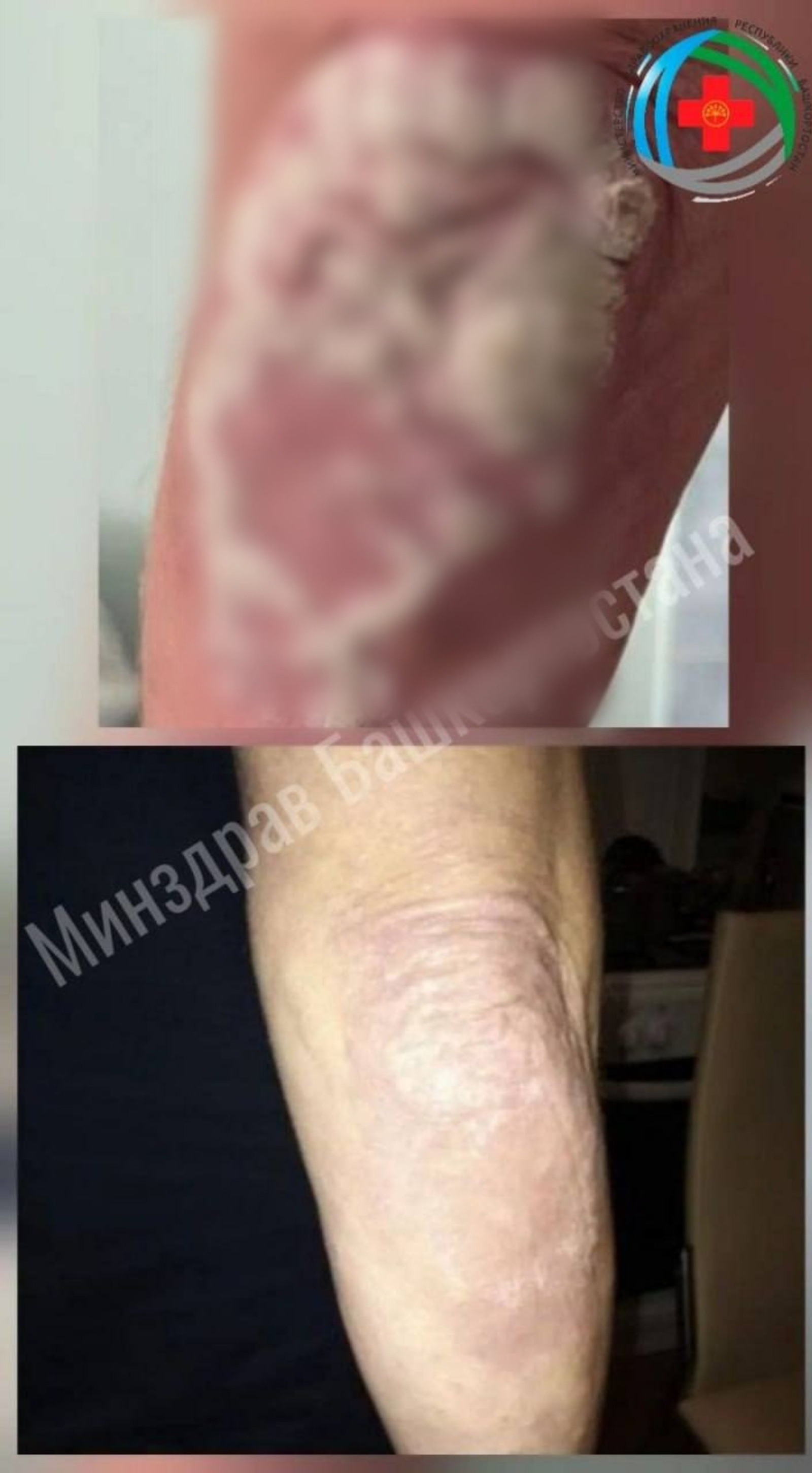 Полностью вылечить псориатический артрит невозможно