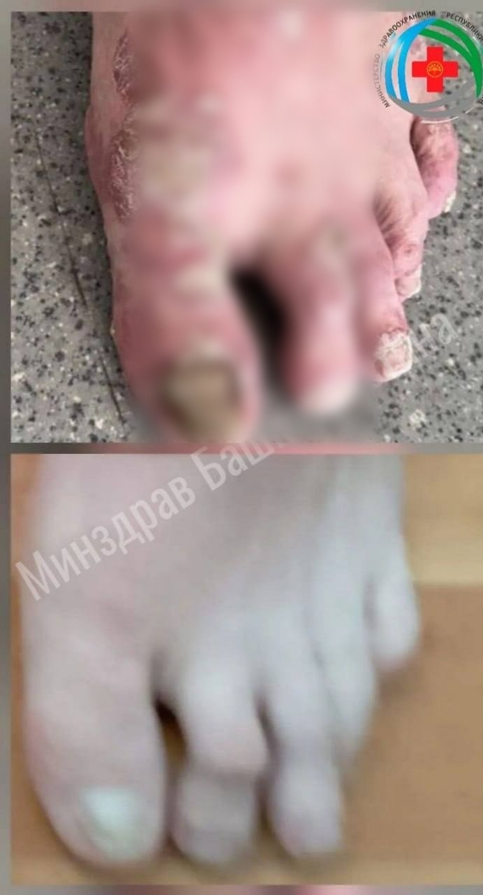 В Башкирии псориатический артрит диагностируют у 2–8 человек на 100 тыс.